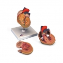 좌심실비대(LVH) 심장 인체 모형